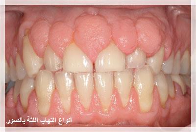 مقالة عن انواع التهاب اللثة بالصور مقالة الصحة
